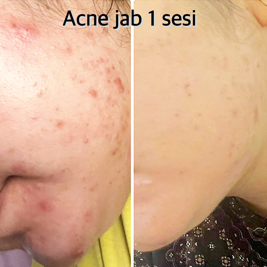 Skin Boosters 4
