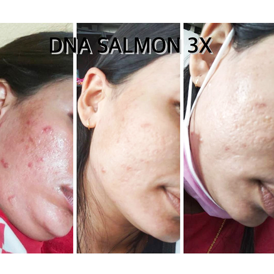 Skin Boosters 6