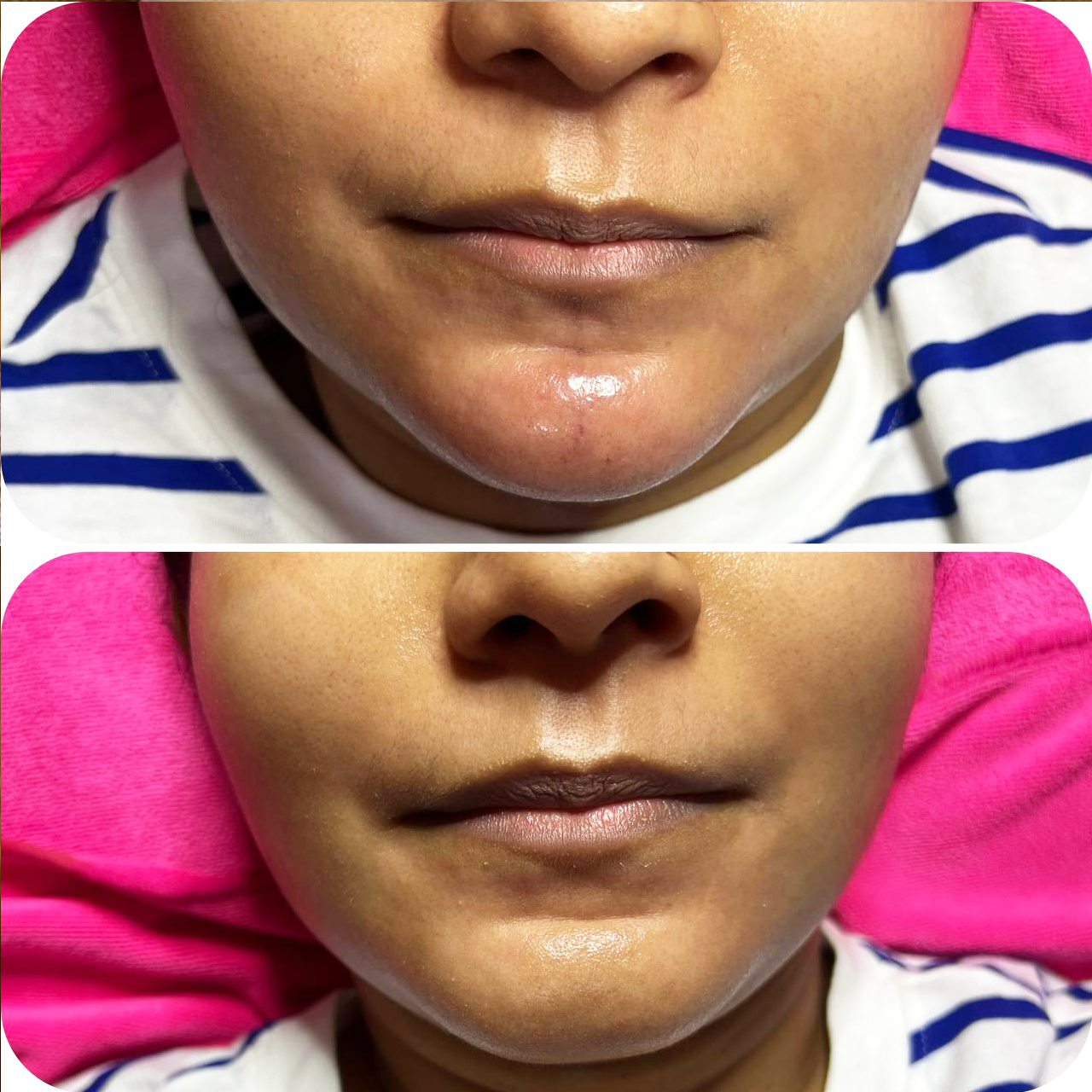 Face Enhancement Chin Enhancement