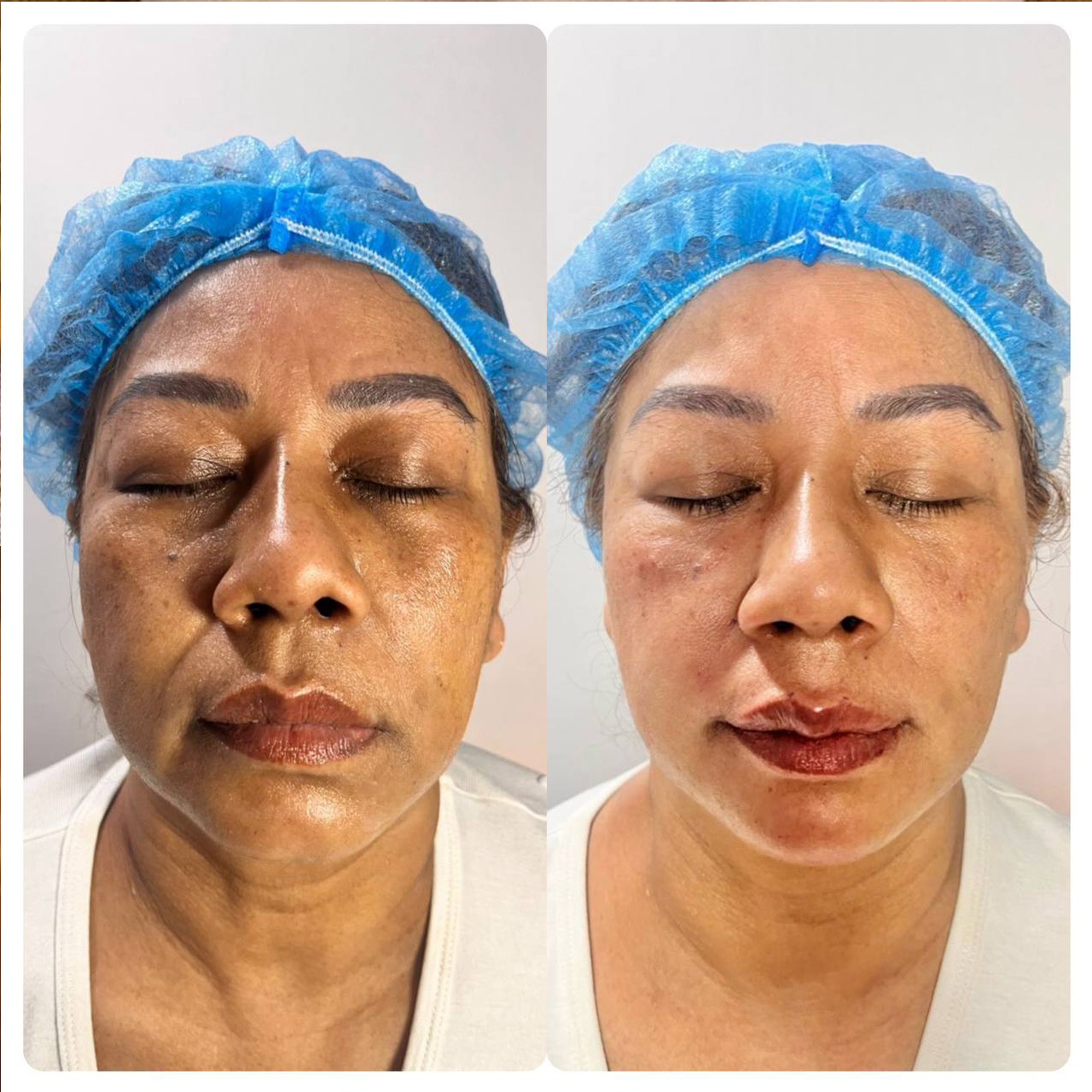 Face Enhancement Full Face Enhancement