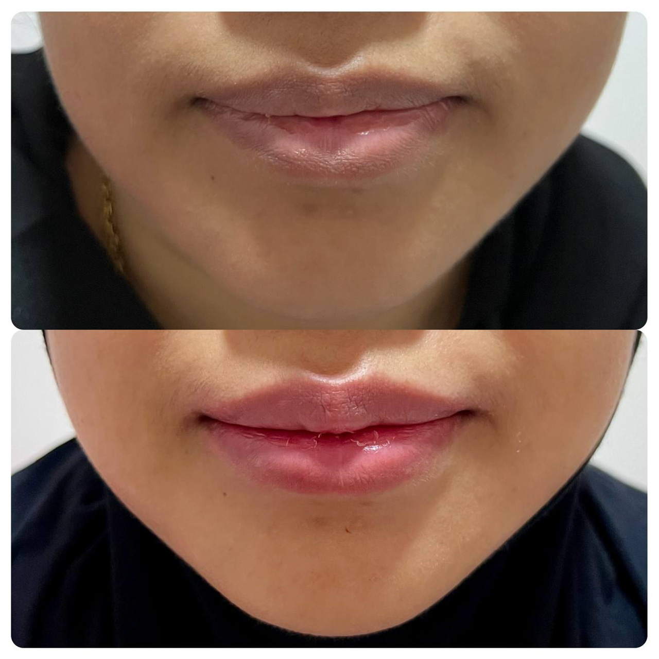 Face Enhancement Lips Enhancement